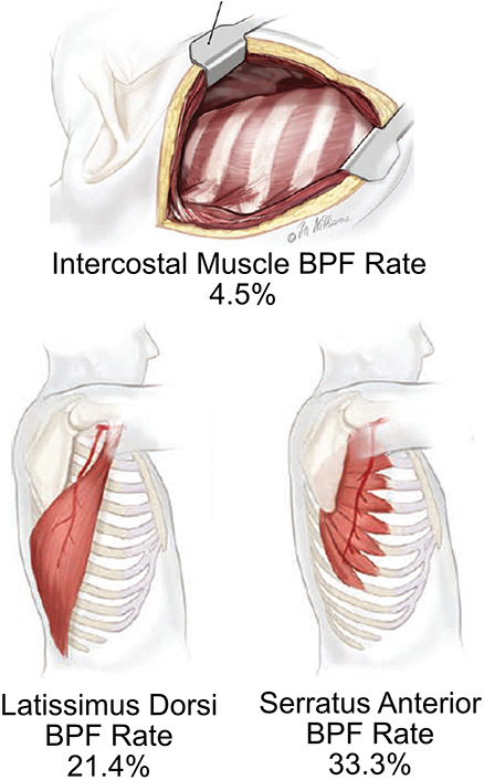 Empiric flap coverage for the pneumonectomy stump: How protective is it? Find out the impact of empiric tissue flaps on bronchopleural fistula rates after pneumonectomy from researchers @BrighamThoracic in this #thoracic #JTCVS article: doi.org/10.1016/j.jtcv…