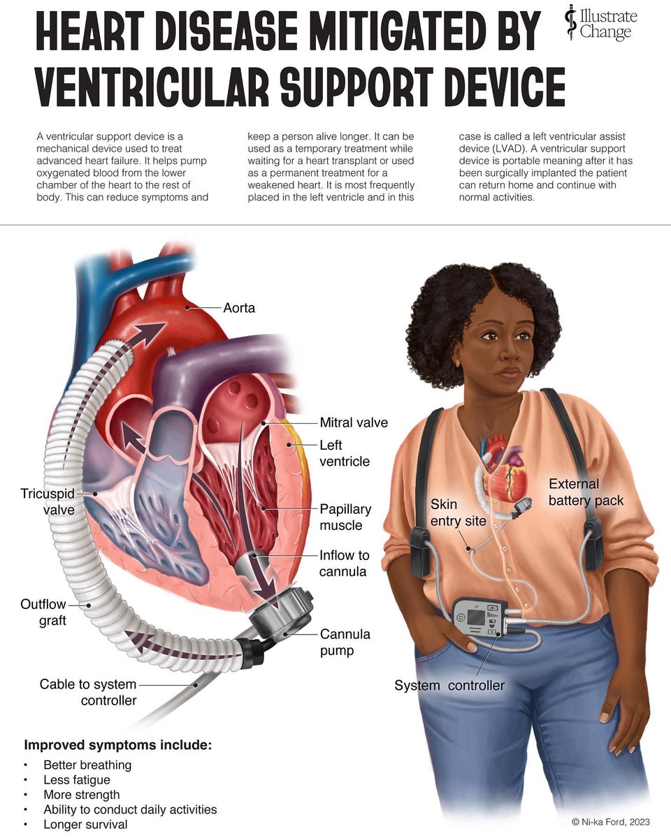 My first illustration for the @AMIdotorg Diversity Fellowship sponsored by @JNJNews on heart disease mitigated by ventricular support device. The illustrations for the fellowship will bring more representation into healthcare imagery and medical education materials. #medart