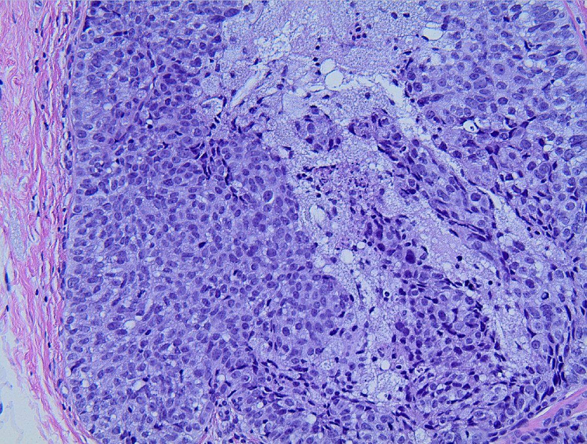 Late Friday intraductal proliferation. Is this DCIS or florid UDH? #breastpath