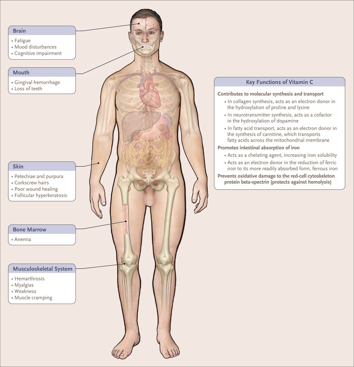 Vitamin C Def. The most common manifestations are corkscrew hairs,  perifollicular hemorrhages, ecchymoses & gingivitis. More severe  manifestations: -🩸: hemolytic anemia, iron/folate deficiency, leukopenia  -♥️: Group 1 PAH (⬇️nitric oxide 