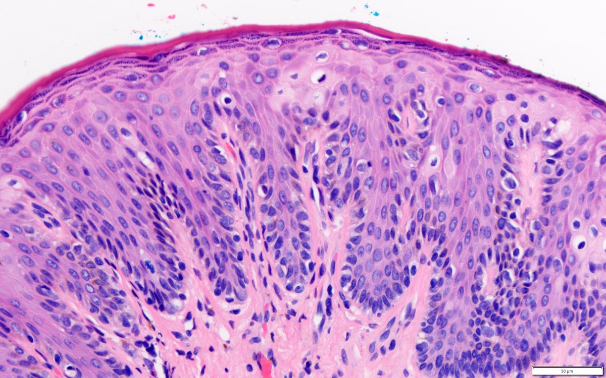 Early lentiginous melanoma in situ of the vulva can be ridiculously subtle. Periclitoral skin of a patient in her early 60s. #dermpath #pathology #GYNpath