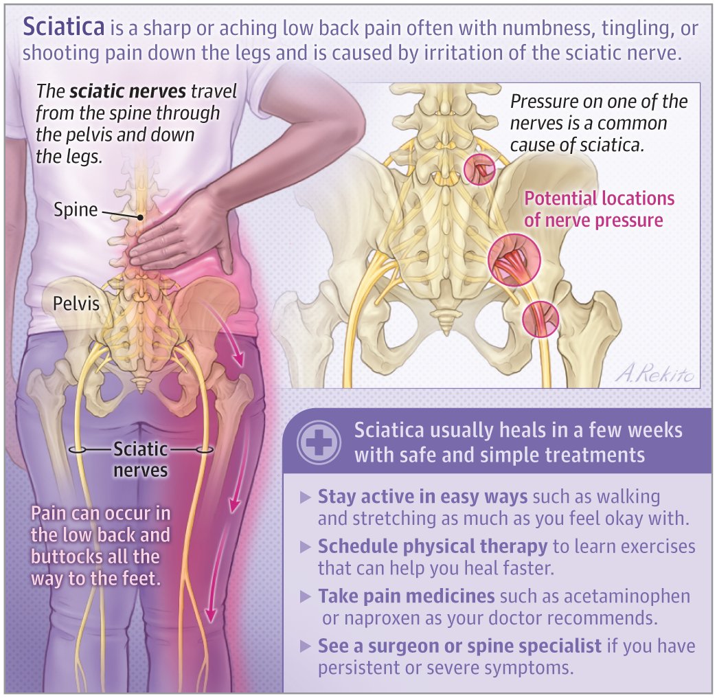 PhysioMeScience's tweet photo. I Am Worried I Have Sciatica—What Do I Need to Know?

https://t.co/IVJpFrOJNr https://t.co/y0090HhAQo
