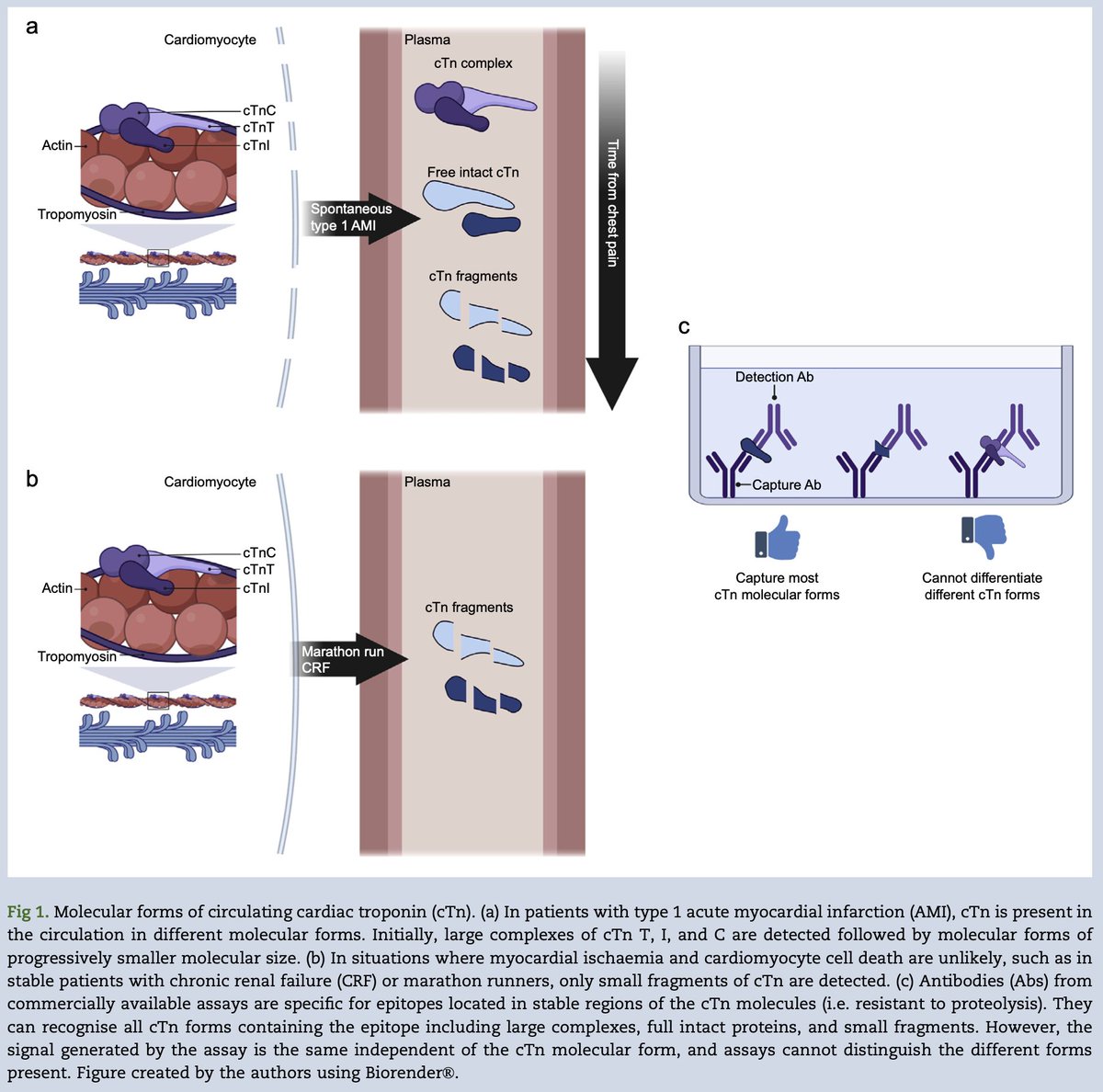 British Journal of Anaesthesia (@bjajournals) on Twitter photo New review: Increased cardiac troponin following noncardiac surgery may be a marker of broad cardiomyocyte stress, not solely ischaemia. Understanding this is important for better perioperative care. #Anaesthesia #Anesthesiology 
bjanaesthesia.org/article/S0007-… New review: Increased cardiac troponin following noncardiac surgery may be a marker of broad cardiomyocyte stress, not solely ischaemia. Understanding this is important for better perioperative care. #Anaesthesia #Anesthesiology 
bjanaesthesia.org/article/S0007-…