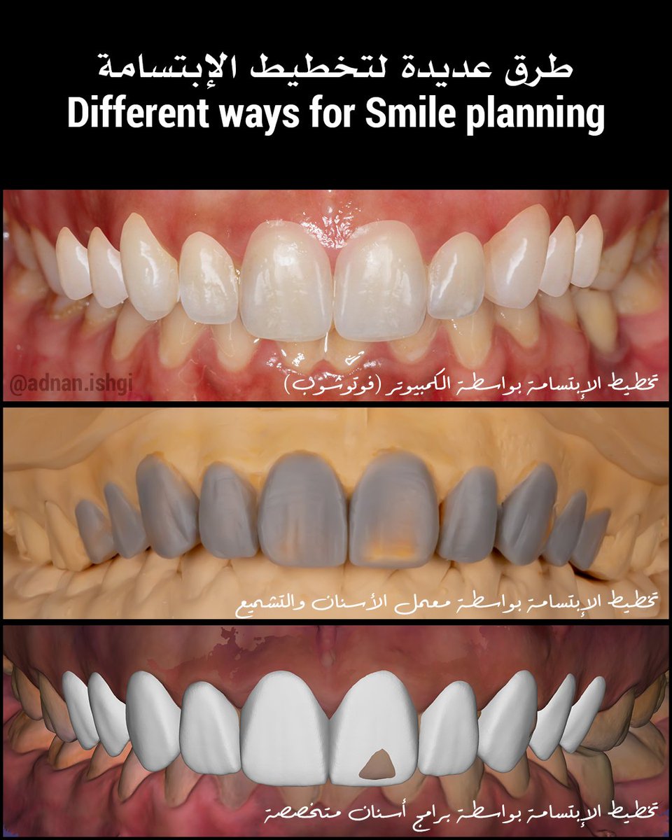 تخطيط الإبتسامة له عدة طرق وهي مهارة أساسية لتجنب الأخطاء الطبية التي نراها في حالات تجميل الأسنان!
Smile planning encompasses various methods and is crucial for preventing the medical errors often encountered in cosmetic dentistry cases!