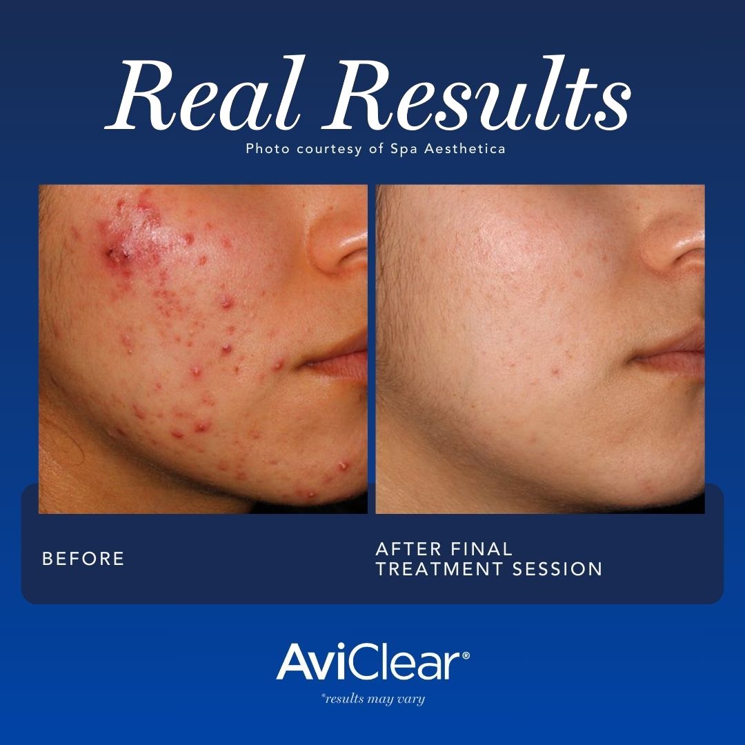 📢 Exciting news! We are thrilled to announce that AviClear Acne Laser is now available in our clinic! Say goodbye to frustrating breakouts and hello to clear, radiant skin! 💫✨

📍 Don't miss out on this incredible opportunity to embrace the power of AviClear Acne Laser!