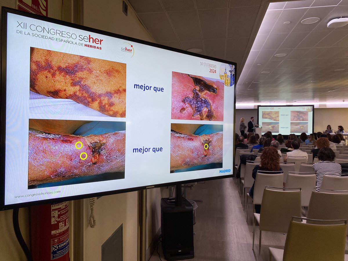 SEHERidas's tweet photo. Hablamos de #calcifilaxis, retos en su diagnóstico y manejo. #12congresoSEHER https://t.co/F8vHjYYUOa