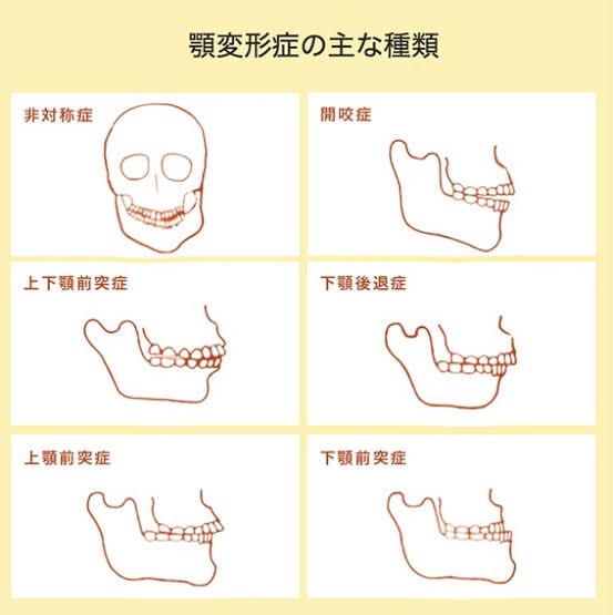agoga_moon's tweet photo. ざっくり作ったので、説明足らずで御免なさい！

歯科矯正で悩む一部は歯並びよりも
実は顎の問題パターンが割といると感じます。
それ保険適用で治せる事を知って欲しい！！😭

私も大人になってから、病名を知りました。
当たり前に認知される病名になり
悩み人を救う存在になってほしいです🙇‍♀️ https://t.co/rg8c0haWkQ