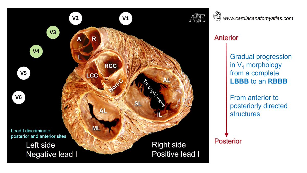 3) 12-lead ECG to predict the site of origin of idiopathic ventricular arrhythmias