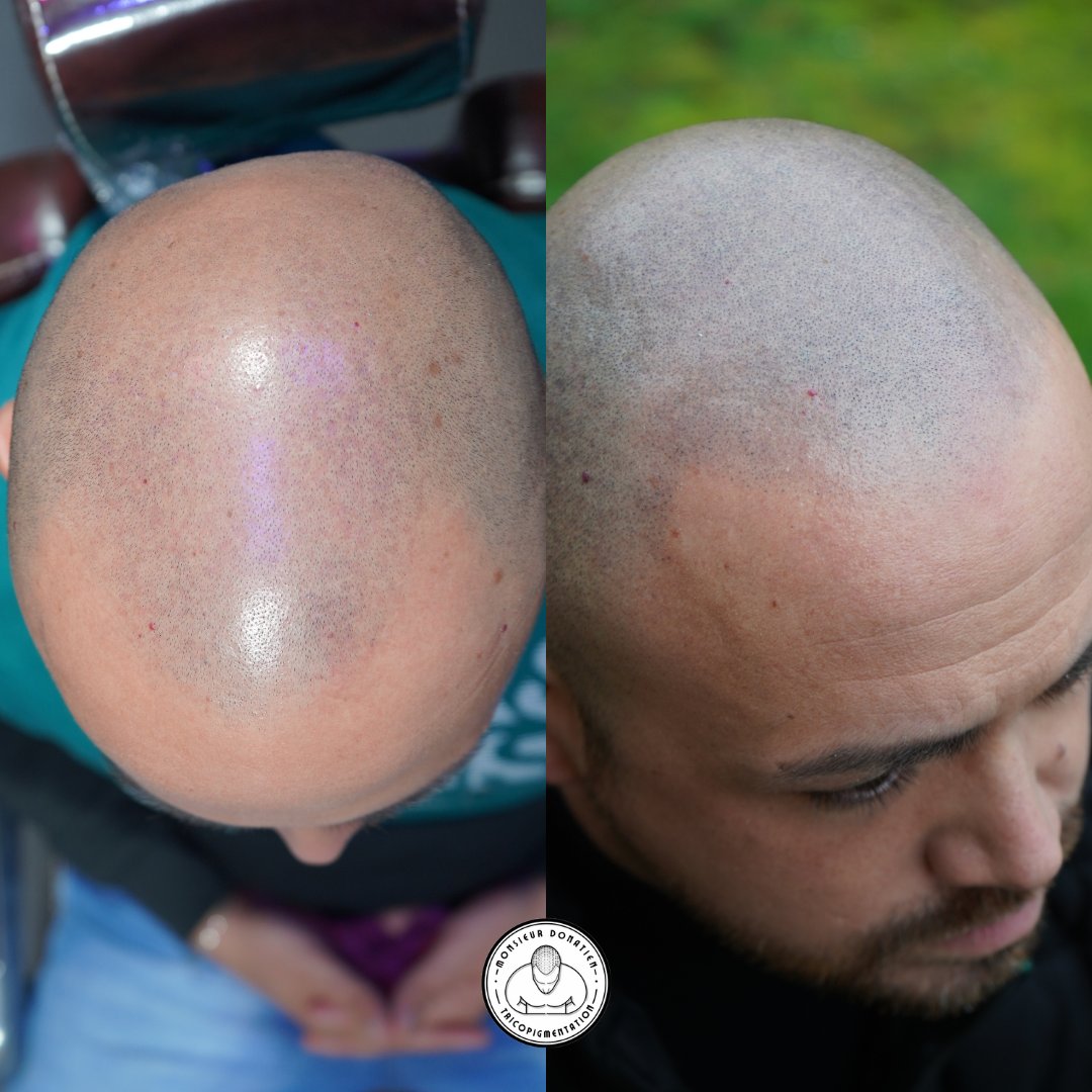 MDonatienRennes's tweet photo. AVANT-APRES Greffe de MicroPigments👨‍🦲Effet crane rasé🌐 https://t.co/NQyLWQ2nut #greffedecheveux #tricopigmentation #dermopigmentation #tatouagecrane #tatouagecheveux #cheveuxrasé #calvitie #alopécie #rennes #bretagne #chauve #monsieurdonatien #tricopigmentationrennes https://t.co/HFMuFDtHwO