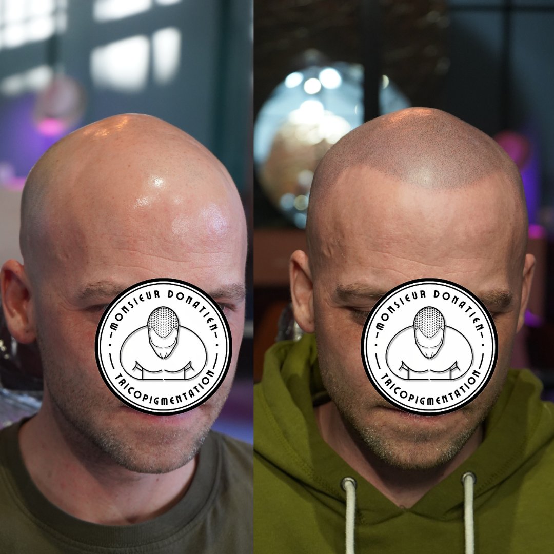 MDonatienRennes's tweet photo. AVANT-APRES Greffe de MicroPigments👨‍🦲Effet crane rasé🌐 https://t.co/NQyLWQ2nut #greffedecheveux #tricopigmentation #dermopigmentation #tatouagecrane #tatouagecheveux #cheveuxrasé #calvitie #alopécie #rennes #bretagne #chauve #monsieurdonatien #tricopigmentationrennes https://t.co/1HaPW1F0Bv