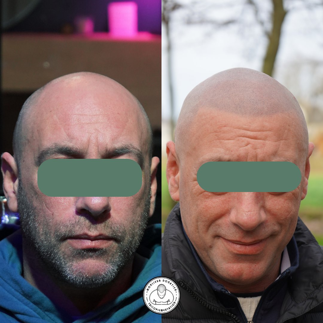 MDonatienRennes's tweet photo. AVANT-APRES Greffe de MicroPigments👨‍🦲Effet crane rasé🌐 https://t.co/NQyLWQ2nut #greffedecheveux #tricopigmentation #dermopigmentation #tatouagecrane #tatouagecheveux #cheveuxrasé #calvitie #alopécie #rennes #bretagne #chauve #monsieurdonatien #tricopigmentationrennes https://t.co/i9vE8sfbb3