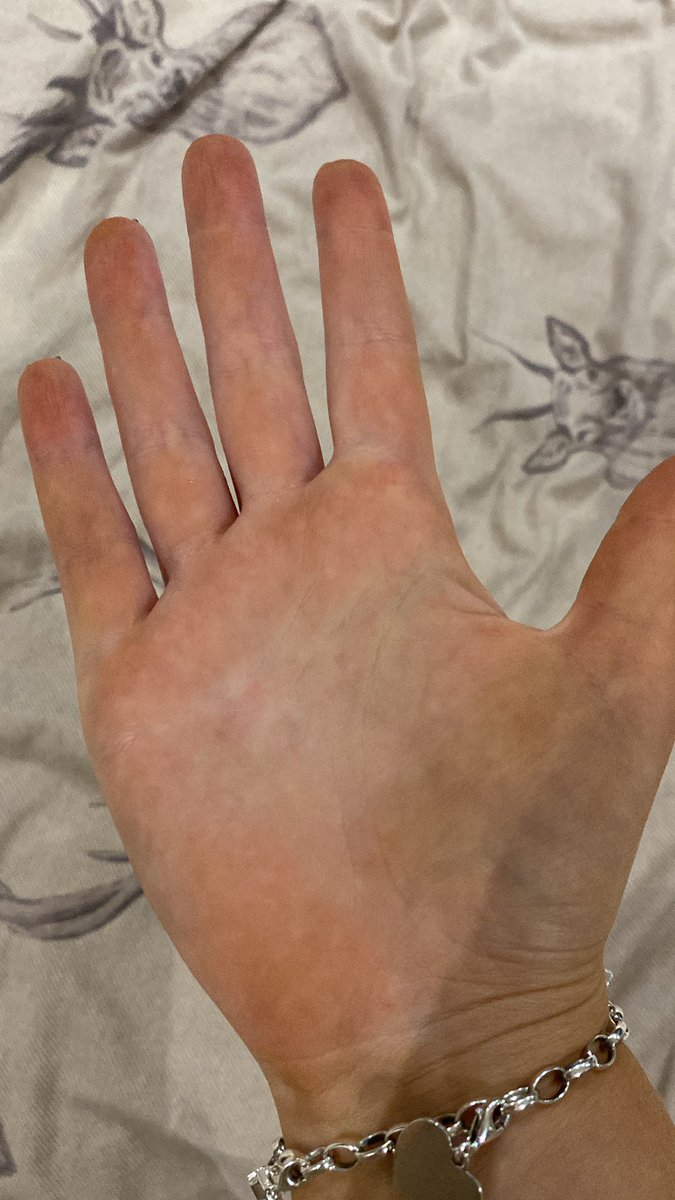 Dizzness's tweet photo. Fake tanned and slept with my hand on my face. 😩 https://t.co/xnJ4n7CoQ6