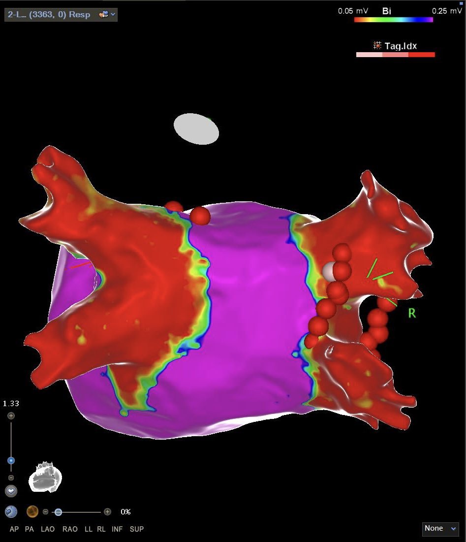 Redo ablation for persisten atrial fibrillation in heart failure. OCTARAY™ Mapping Catheter provides shorter and more efficient mapping times and fast gap identification. Last but not least, near-zero X-ray.