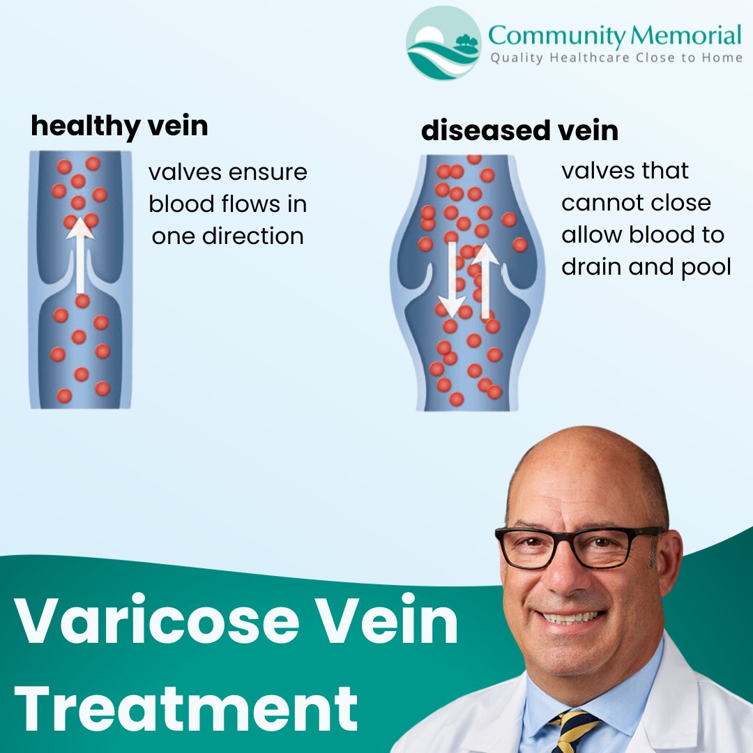 Dr. Ripich is welcoming patients in the Caz and Hamilton offices for varicose vein treatment! This innovative and minimally invasive treatment brings relief to those suffering - call for information! 315.648.6408