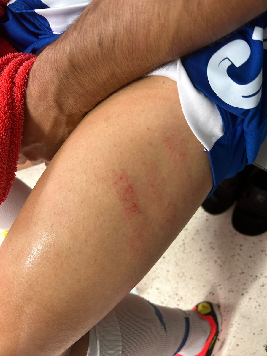 A coxa de Gabriel Brás ao intervalo, depois da pancada que sofreu na área e que árbitro não viu e VAR não quis ver (se viu e não sinalizou ao árbitro é porque é demasiado incompetente para arbitrar competições profissionais).