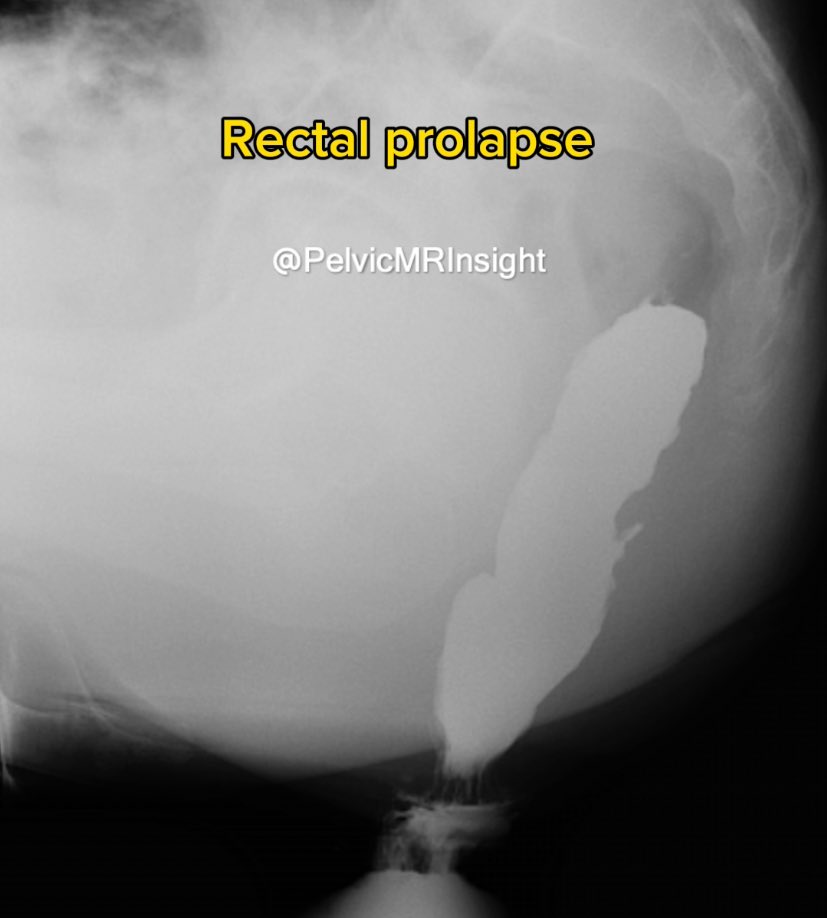 📣 ANSWER📣
Complete extra-anal rectal prolapse. 

#defecography #Pelvicfloor #Radiology #Xray #barium #proctography #rectalprolapse