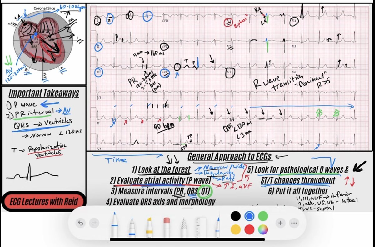 Here is my systematic approach to every #ECG. In this video, I apply this approach to a Normal Sinus Rhythm and explain normal ECG waveforms from an anatomical point of view! ⤵️

Anatomic Approach to ECG: Normal Sinus Rhythm
youtu.be/WGhKgCDmKBE