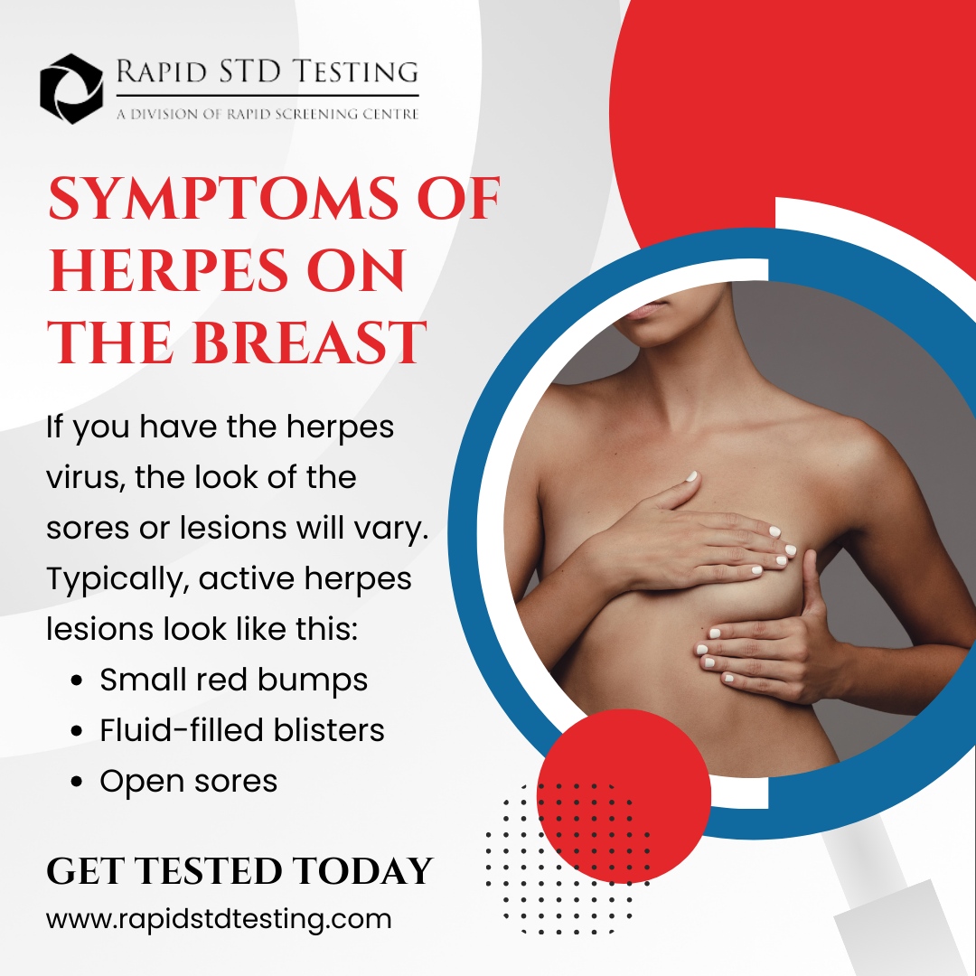Recognizing herpes on the breast: If you have the virus, lesions vary but often present as small red bumps, fluid-filled blisters, or open sores.

Vigilance and timely consultation are key for proper management. 🩹🔍

#HerpesAwareness #HealthCare #rapidstdtesting