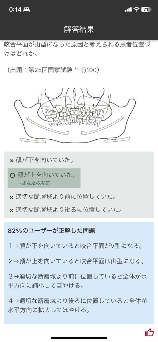 dental_mai20's tweet photo. 咬合平面
下向き→V字型　上向き→山型
適切な断層域より前→全体が水平方向に縮小してぼやける
適切な断層域より後ろ→全体が水平方向に拡大してぼやける https://t.co/bso1j6NPPC