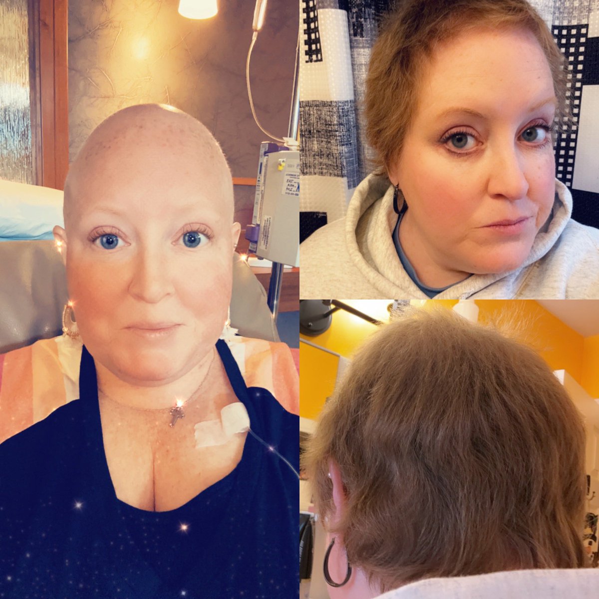 KTredsquirrel's tweet photo. 6 months of hair growth! #breastcancersurvivor #hairgrowth https://t.co/S5Zj8hjY9e