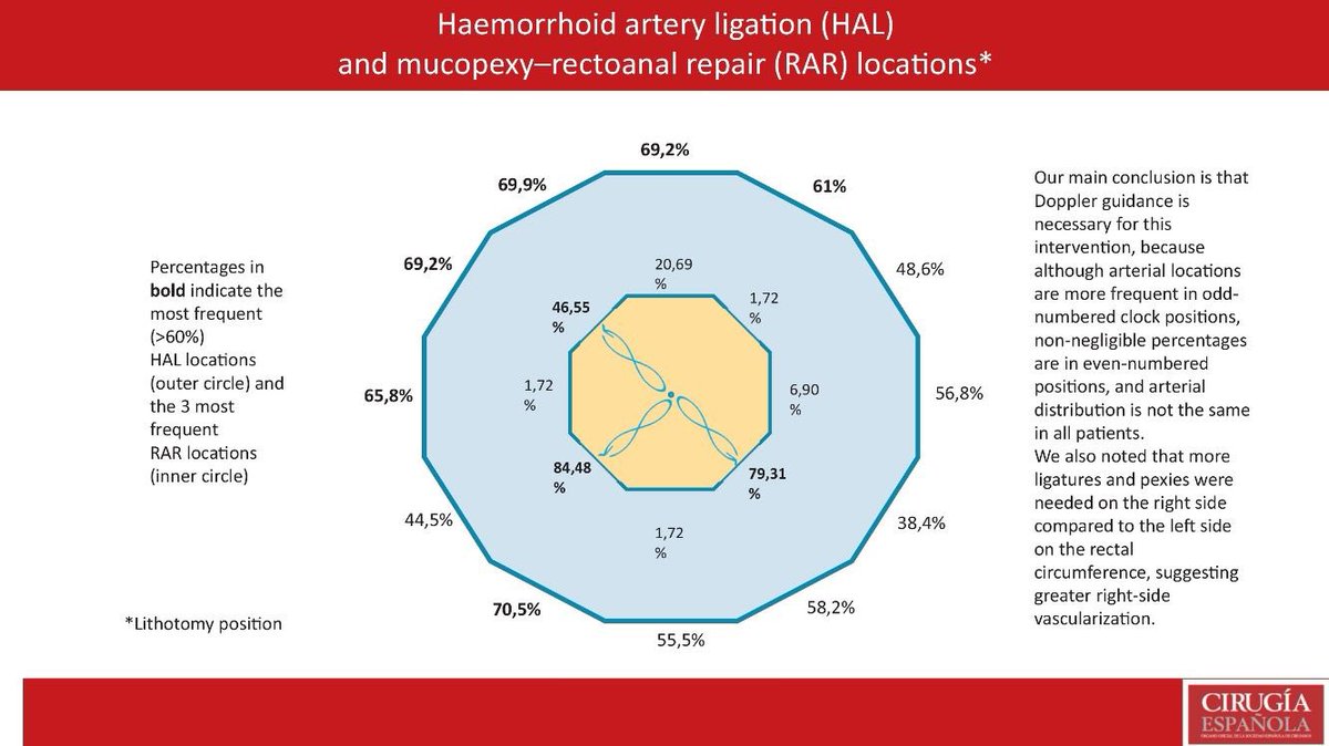Haemorrhoidal artery distribution in patients with grade III and IV #haemorrhoids treated with artery ligation and rectoanal repair. Assessment of #Doppler guidance 🆕 #CirEsp #HAL

@aecirujanos @coloproctoaec @AECP_FAECP @me4_so 

🔗elsevier.es//es-revista-ci…