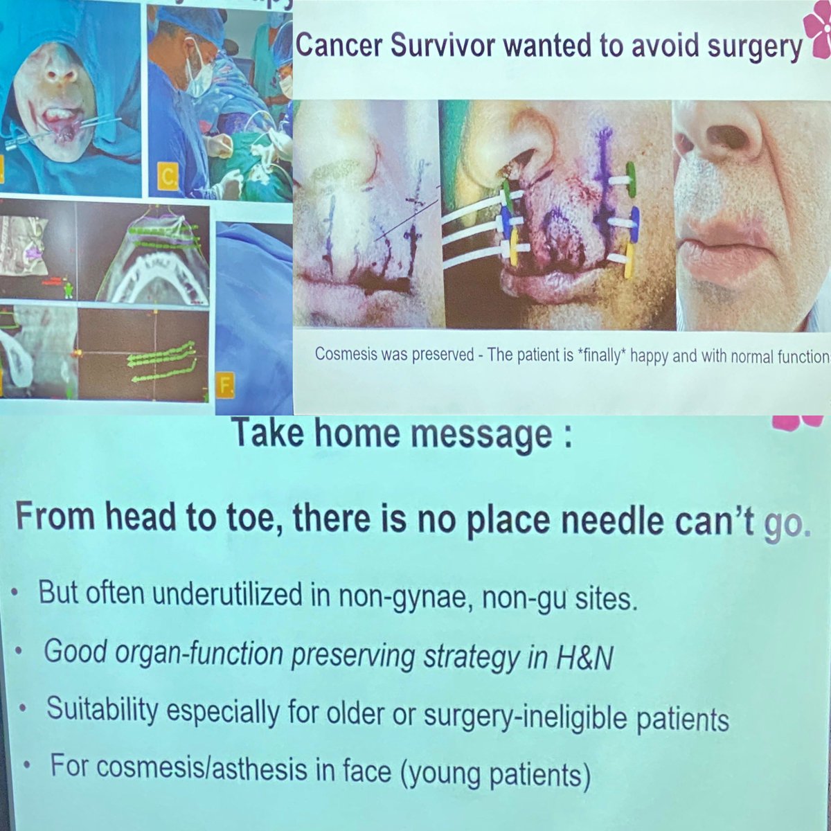 Australasian Brachytherapy Group (@ausbrachy) on Twitter photo #ABG2024 Global BT session. Humbling, and inspirational session from <a href="/KtmCancerCenter/">Kathmandu Cancer Center</a> <a href="/SimitSapkota/">simit</a> <a href="/supKCC/">Subhas Pandit, MD</a> the breadth of brachy done reminds us of what is possible. #ABG2024 Global BT session. Humbling, and inspirational session from <a href="/KtmCancerCenter/">Kathmandu Cancer Center</a> <a href="/SimitSapkota/">simit</a> <a href="/supKCC/">Subhas Pandit, MD</a> the breadth of brachy done reminds us of what is possible.