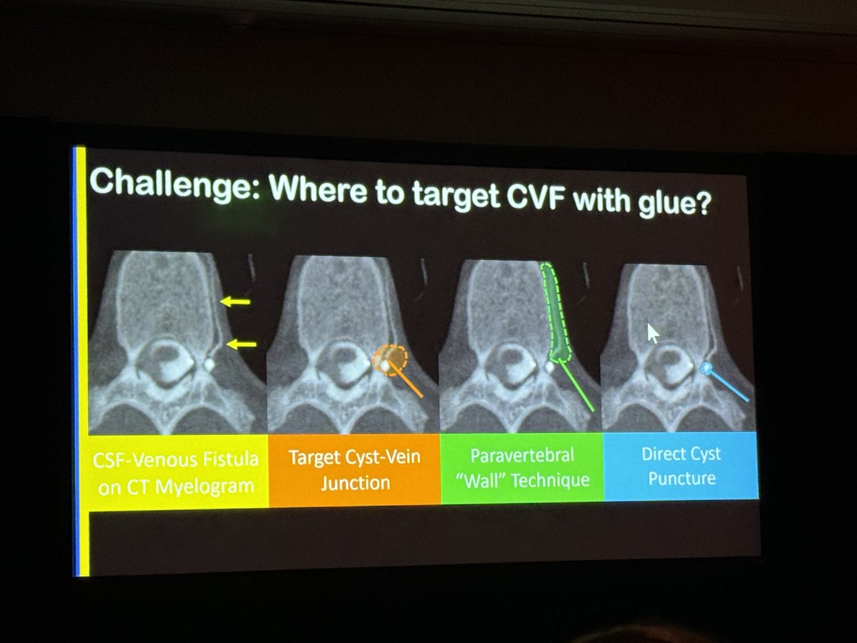 Always important points from @MarkMamloukMD SIH Dilemmas and Challenges! Come join me if you're attending American Society of Spine Radiology (ASSR) 27th Annual Symposium. #ASSR24 #NeuroRad - via #Whova event app