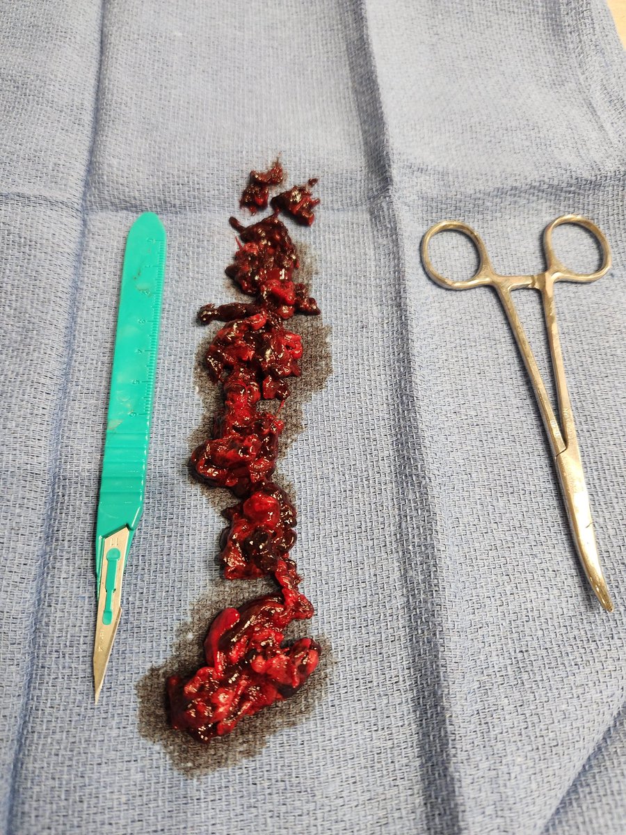 ChayaPeace's tweet photo. @DrJohnCampbell3 I am still clotted.  The image on the far right was first clot taken out of me.  Second and third from right taken out in second procedure.   Far left taken out 2 weeks ago.  I have oclusive and non oclusive clots in my left leg causing great pain. https://t.co/E0qgSUPCjw
