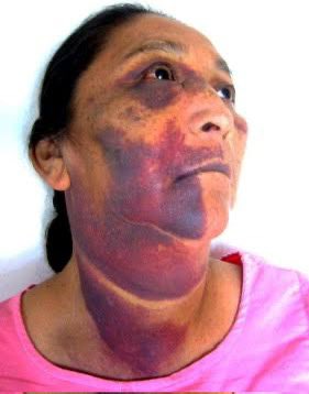 Naocl (sodyum hipoklorit) taşması. Şu olay öğrencilik zamanımda başıma gelse bir daha kendime gelemem sanırım. En çok korktuğum komplikasyonlardan biri.