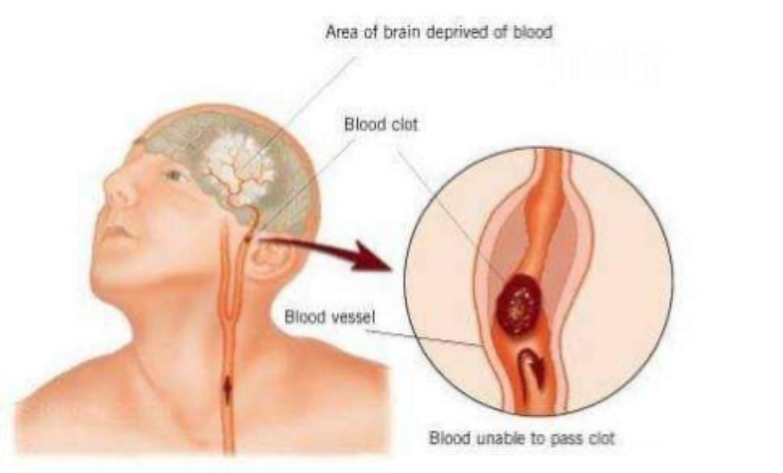 توفي مراهق مكسيكي بعد ان تم تقبيلة من قبل صديقته على رقبته بشكل قوي حيث تسببت هذه القبلة في حدوث جلطة في الوريد ثم الى الوفاة