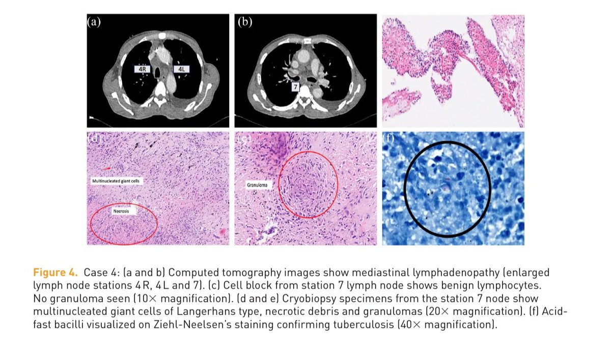 Our work on a relatively new #bronchoscopy technique called #EBUS mediastinal nodal #cryobiopsy, now available as a case series at Therapeutic Advances in Respiratory Diseases