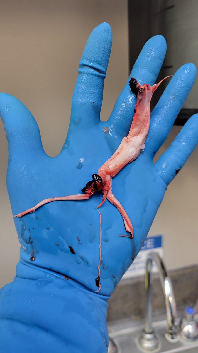 Johnincarlisle's tweet photo. This one is from the carotid artery after death, (thanks to Richard Hirschman). Seems to be a new pathology, we need answers, these things exist! https://t.co/4YaRERblw7