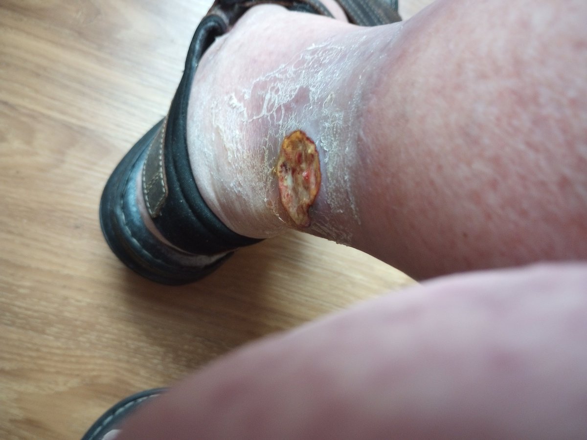 MageX0's tweet photo. Nice &amp; Meaty wound caused by "Improper" Treatment at Nursing home... You can just imagine how much this hurts me everyday... https://t.co/s7NV40EWnb