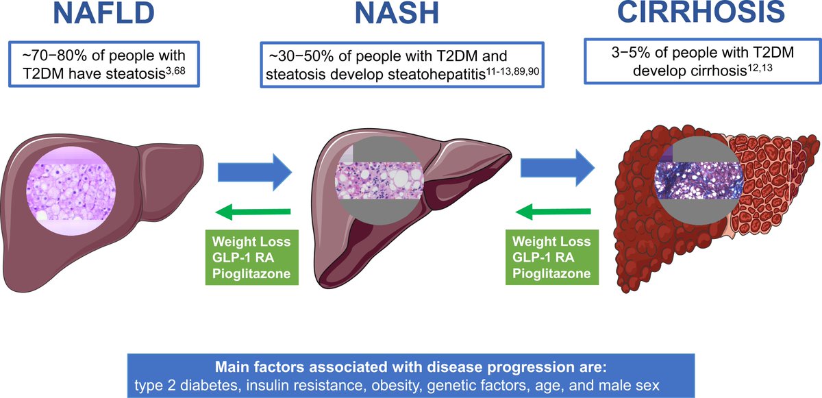 Insulin resistance is implicated in both the pathogenesis of #MASLD and its progression from steatosis to steatohepatitis, cirrhosis, and even hepatocellular carcinoma. @ADA_Pubs @AmDiabetesAssn 
diabetesjournals.org/spectrum/artic…