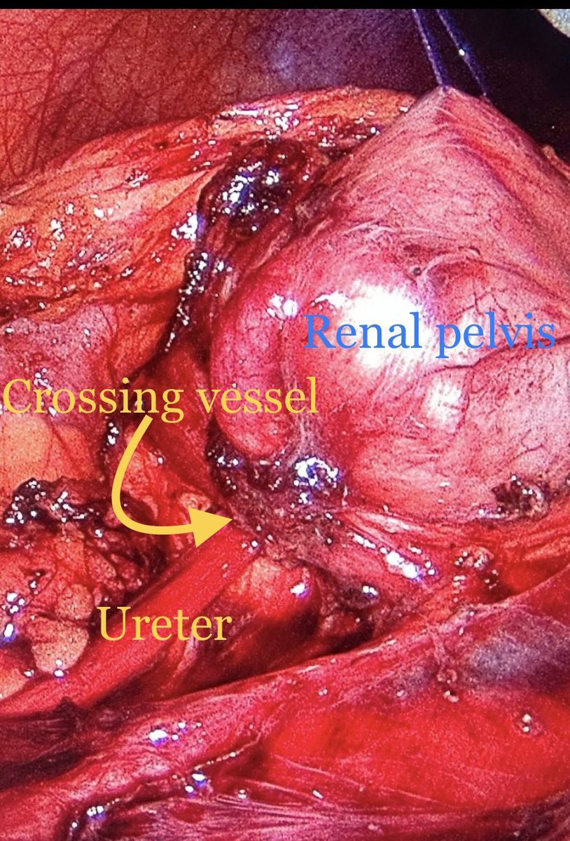 AcademicOner's tweet photo. ๐ฌ๐ ๏ธ Captured on laparoscopy: a crossing vessel causing UPJ obstruction. This common condition is complex and demands precise surgical intervention. @tayfunoktar @profdrkurtulus #Urology #Laparoscopy #UPJObstruction https://t.co/ptIDtsVOtp