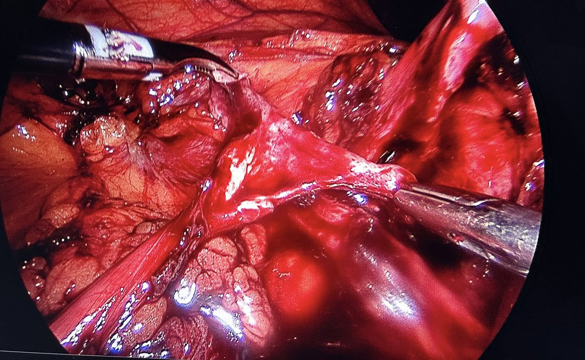 AcademicOner's tweet photo. ๐ฌ๐ ๏ธ Captured on laparoscopy: a crossing vessel causing UPJ obstruction. This common condition is complex and demands precise surgical intervention. @tayfunoktar @profdrkurtulus #Urology #Laparoscopy #UPJObstruction https://t.co/ptIDtsVOtp