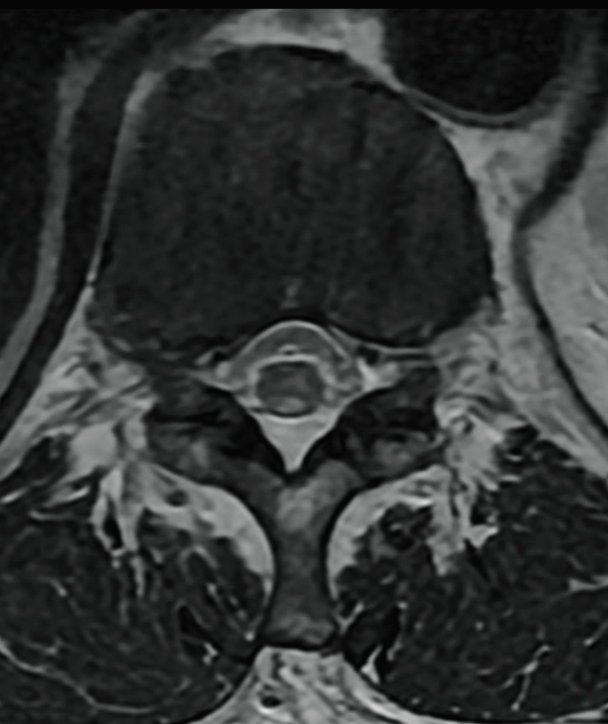 #NeuroTips 🇪🇸 🧠VIH de larga evolución con debilidad lentamente progresiva de las EE.II y trastornos de la marcha ¿Diagnóstico? _ 🇬🇧🧠 Long-term HIV with slowly progressive weakness of the lower limbs and gait disorder Diagnosis?