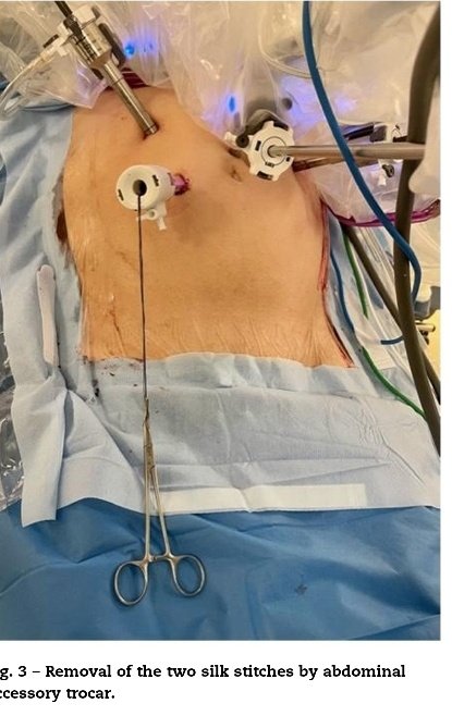 'Absence of thoracotomy by intrathoracic manual suture and transabdominal removal of surgical specimen during Ivor Lewis #robotic esophagectomy'

#Innovationinsurgicaltechnique #upperGI 🤖🦾

@aecirujanos @AEC_CEG #CirEsp

🔗🇬🇧elsevier.es/en-revista-cir…

 🔗🇪🇦elsevier.es//es-revista-ci…
