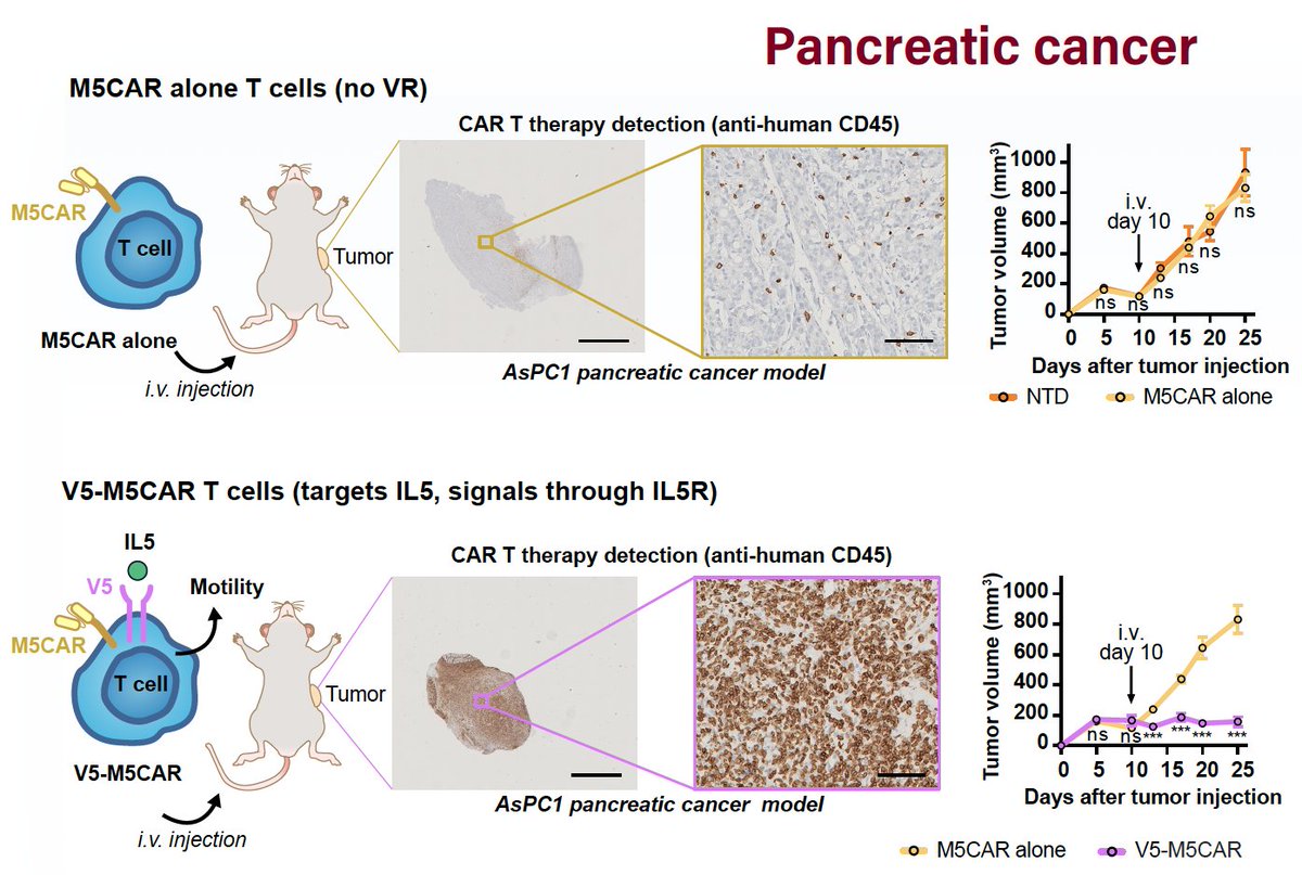 deniswirtz's tweet photo. We have developed a repertoire of >30K velocity receptors that enhance CAR T cell infiltration into solid tumors.

We tested one of these for pancreatic tumors (bottom) that showed far better infiltration than standard mesothelin CAR T cells (top).

Here: https://t.co/bfAty2caj2 https://t.co/0Mlyrkgfv2