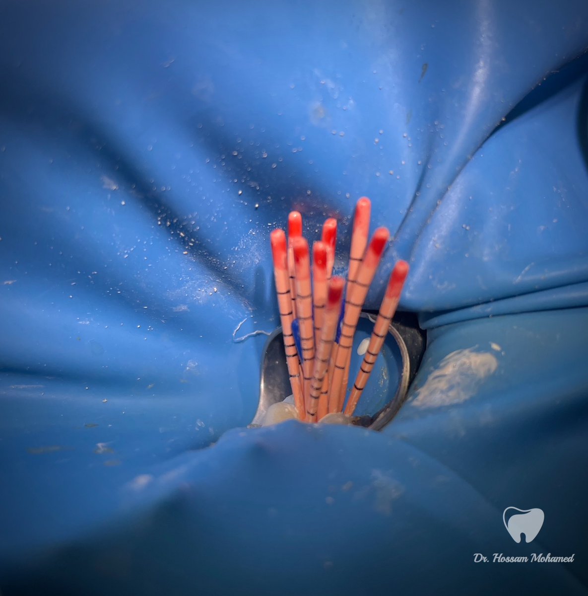 HossamMkhalaf's tweet photo. Endodontic treatment for upper right 6 🦷
الحمد لله ♥️ https://t.co/bEIfdmBQ5l
