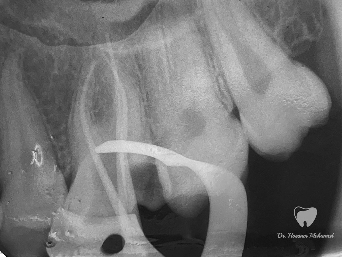HossamMkhalaf's tweet photo. Endodontic treatment for upper right 6 🦷
الحمد لله ♥️ https://t.co/bEIfdmBQ5l
