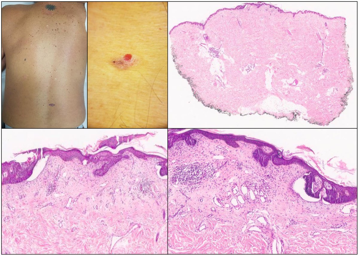 Vol 57   (1). Sonia García-Fuertes et al. Collision tumours in skin: usually an   incidental finding. A retrospective study with literature revision.   elsevier.es/es-revista-rev…
