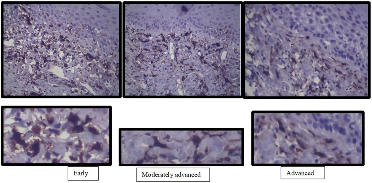 Vol 57   (1). Sheetal Choudhari y col. Vinculación de la inflamación y la angiogénesis   con la fibrogénesis: expresión de FXIIIA, MMP-9 y VEGF en la fibrosis   submucosa oral.   elsevier.es/es-revista-rev…