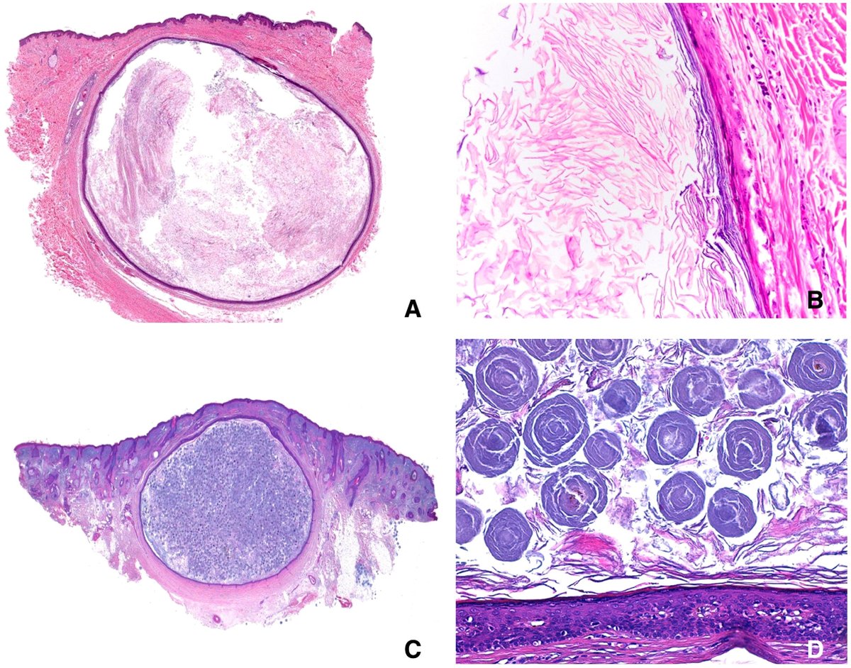 Vol 57   (1). María Teresa Fernández Figueras et al. Main Types of Cysts in   Dermatopathology: Part 1.   elsevier.es/es-revista-rev…