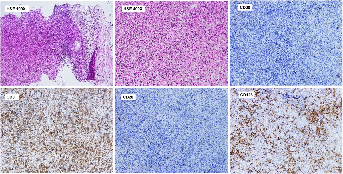 Vol 57   (1). Germán Moreno de Juan et al. Kikuchi–Fujimoto disease type lymph node   reaction with increased plasmacytoid dendritic cells may appear as a side   effect following COVID-19 vaccination: Report of a case and literature   review. elsevier.es/es-revista-rev…