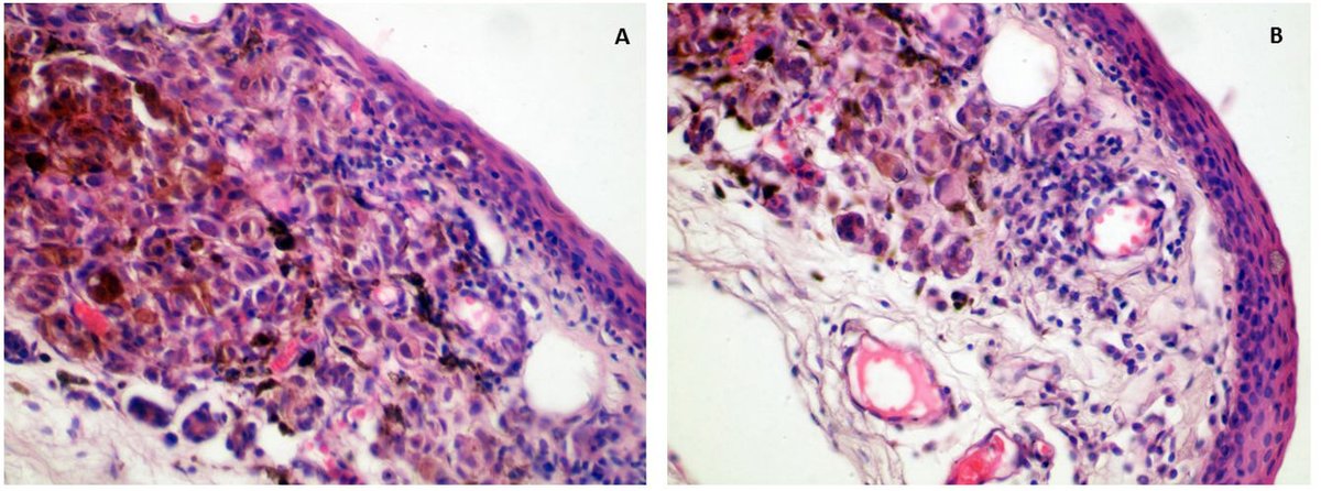 Vol 57   (1). Caridad Socorro Castro et al. Histopathological interpretation of   biopsies for melanocytic tumours in unusual locations.   elsevier.es/es-revista-rev…