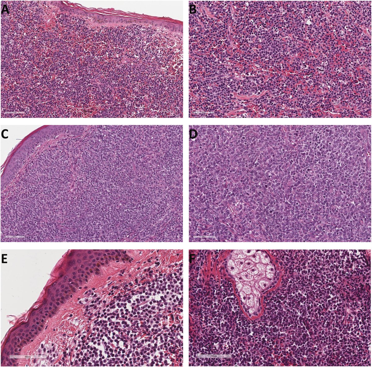 Vol 57   (1). Iván Rienda et al. Clinicopathological diagnosis of blastic plasmacytoid   dendritic cell neoplasm: Report of three cases.   elsevier.es/es-revista-rev…