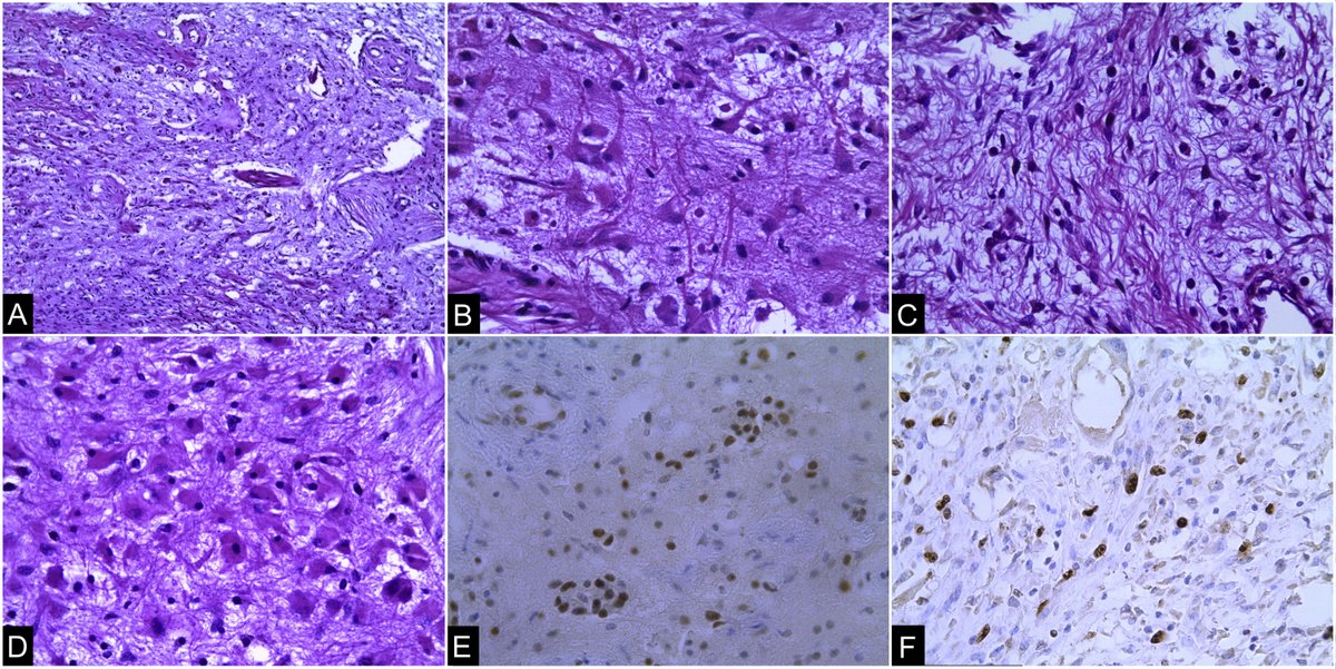 Vol 57   (1). Eduardo Alfredo González Murillo et al. Low-grade astrocytoma within a   retroperitoneal teratoma: Case report.   elsevier.es/es-revista-rev…