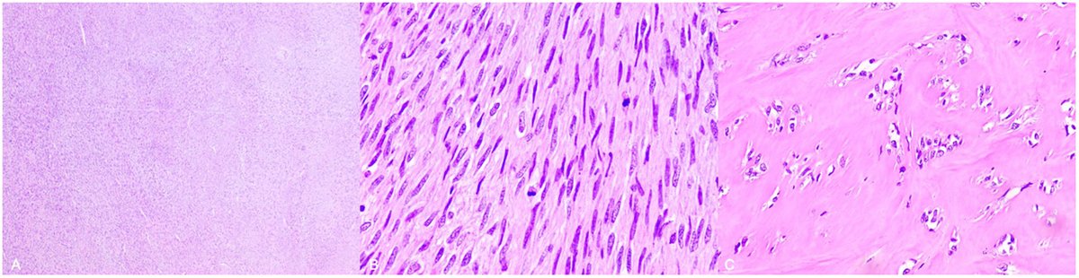Vol 57 (1). Diogo Nóbrega Catelas et al. Malignant “triton” tumor of the lower extremity with a history   of fracture.   elsevier.es/es-revista-rev…