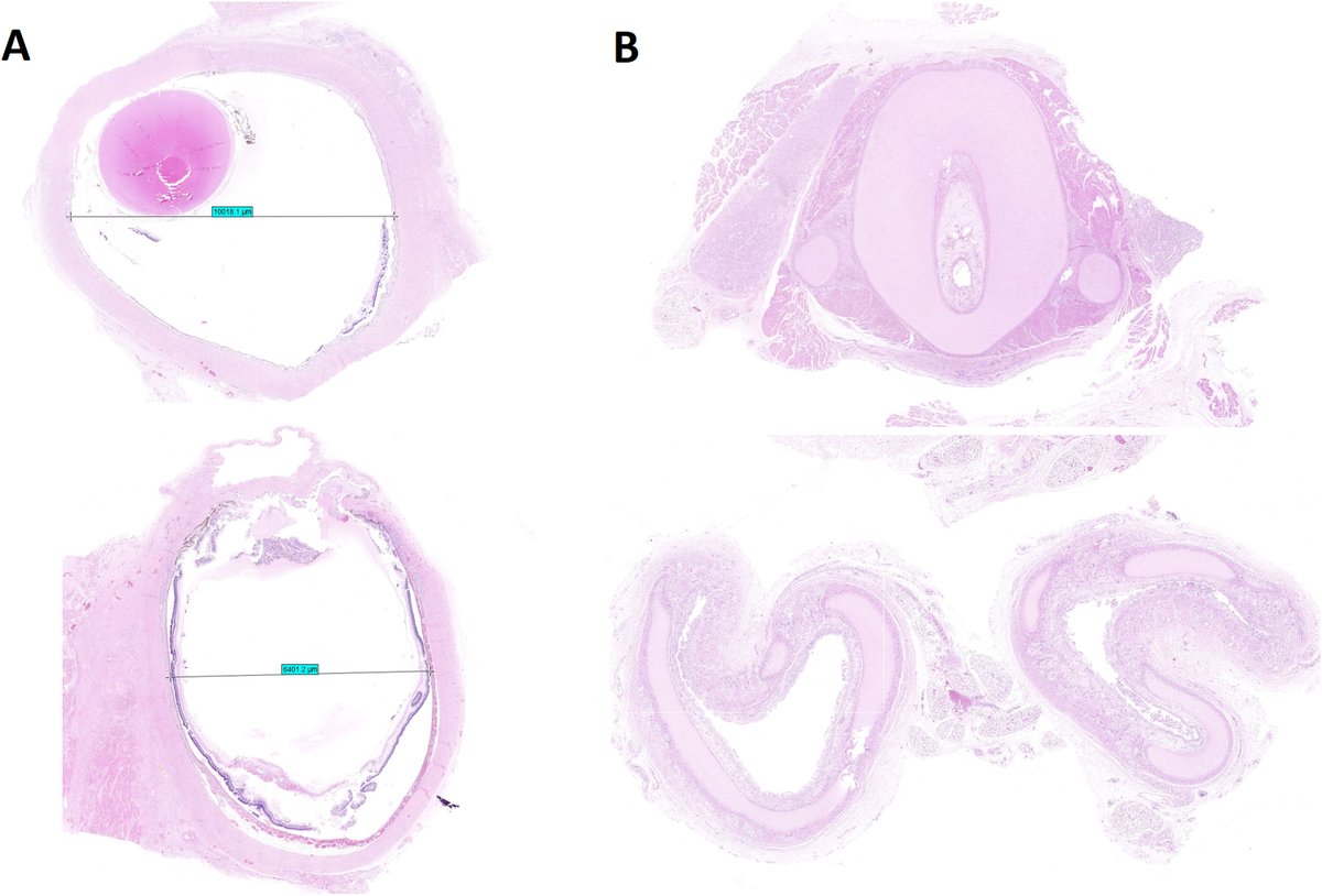 Vol 57   (1). Laura Sánchez Godoy et al. About a case of Fraser syndrome. Autopsy of a   37 weeks gestation fetus with multiple malformations.   elsevier.es/es-revista-rev…